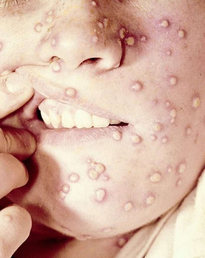 2022 Monkeypox outbreak